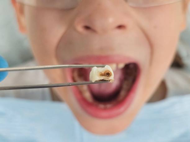 Best Emergency Treatment for Dental Infections or Abscesses in Roseland, FL