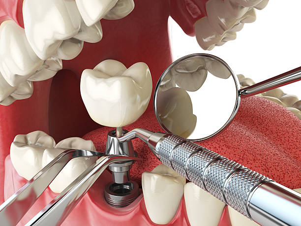 Best Emergency Wisdom Teeth Removal in Roseland, FL